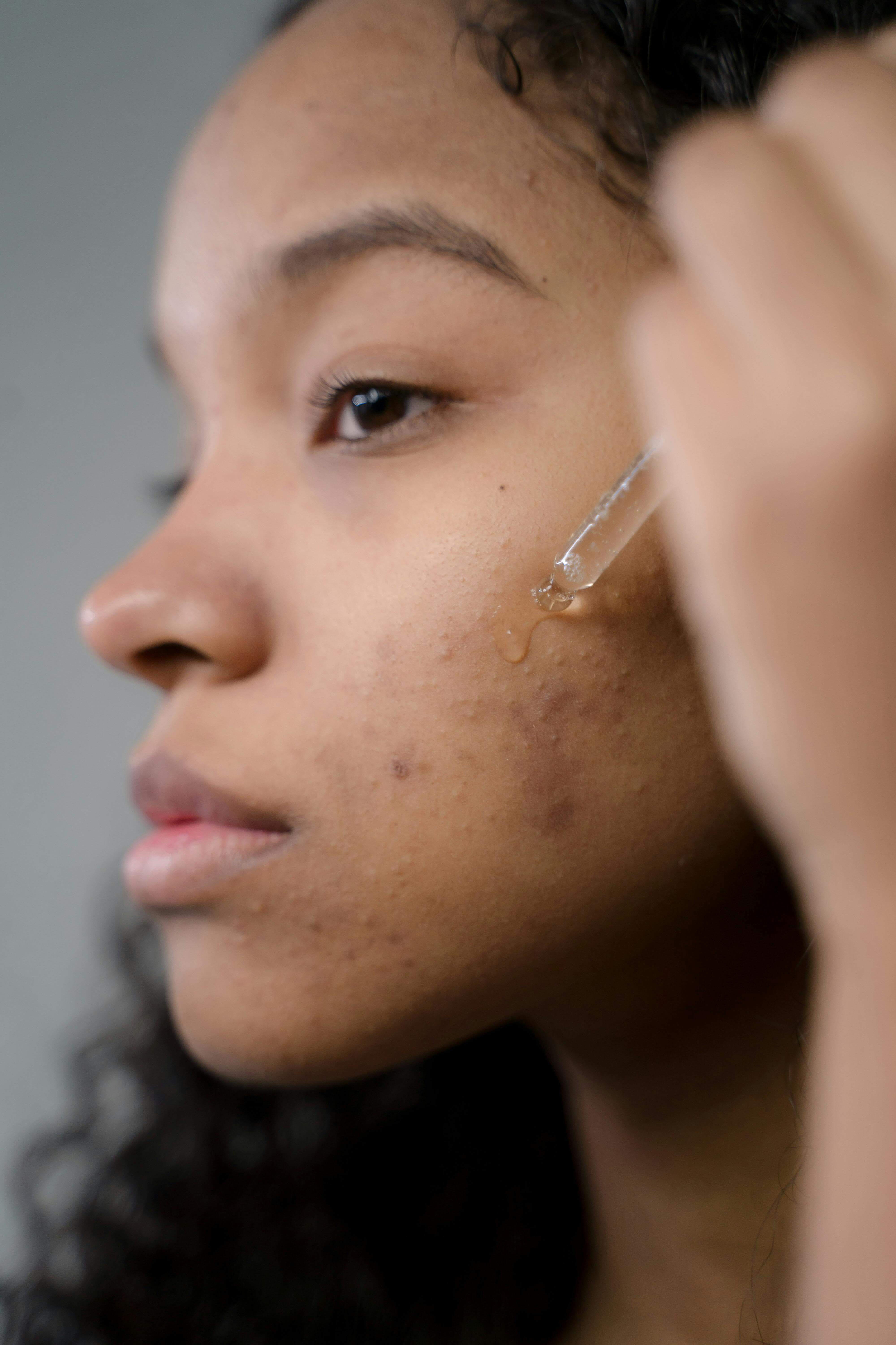 Facial Antiacné
